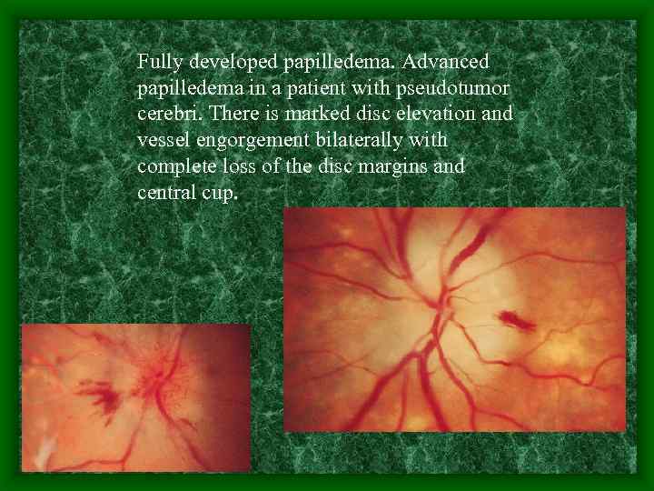 Fully developed papilledema. Advanced papilledema in a patient with pseudotumor cerebri. There is marked