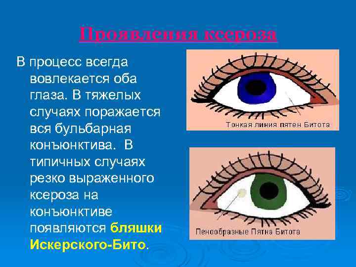 Проявления ксероза В процесс всегда вовлекается оба глаза. В тяжелых случаях поражается вся бульбарная