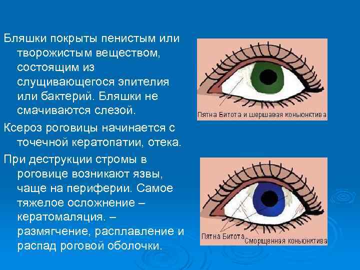 Бляшки покрыты пенистым или творожистым веществом, состоящим из слущивающегося эпителия или бактерий. Бляшки не