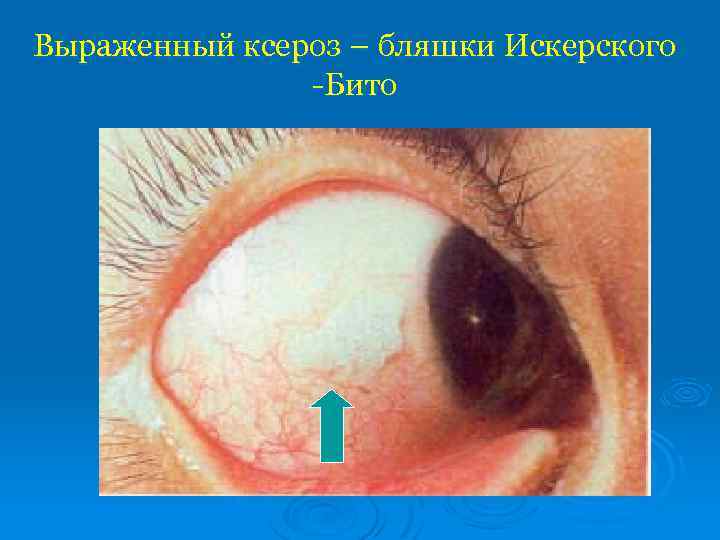 Выраженный ксероз – бляшки Искерского -Бито 