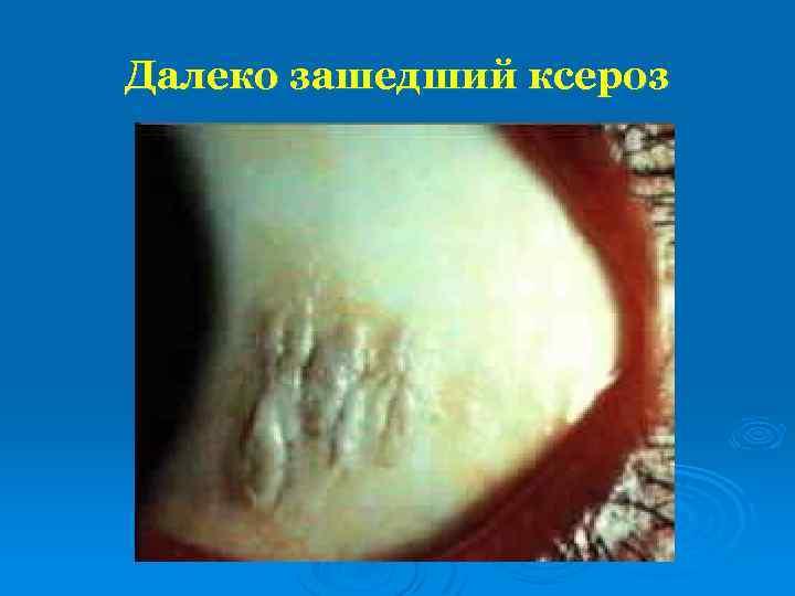 Далеко зашедший ксероз 