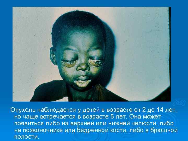  Опухоль наблюдается у детей в возрасте от 2 до 14 лет, но чаще