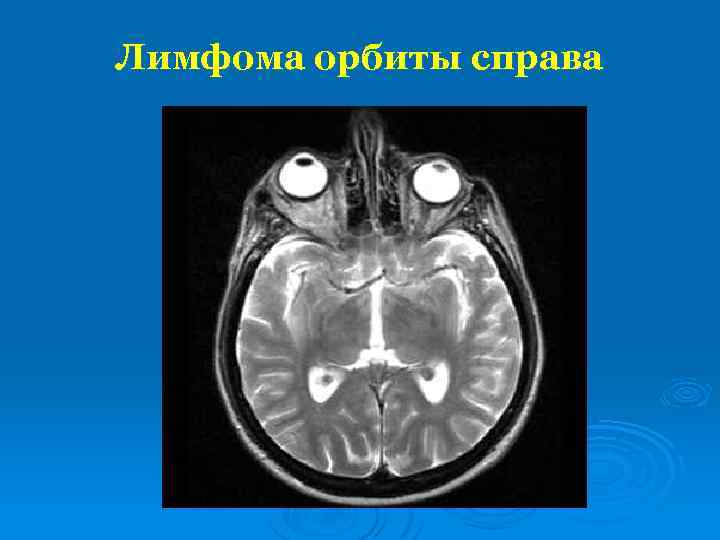 Лимфома орбиты справа 