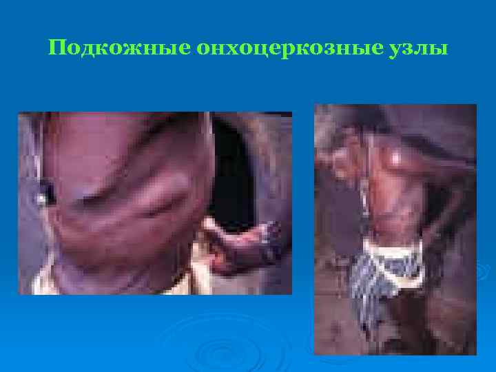Подкожные онхоцеркозные узлы 