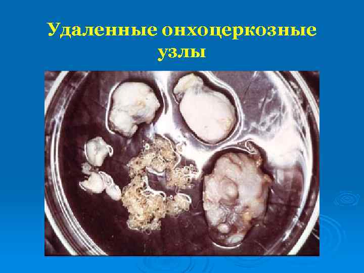 Удаленные онхоцеркозные узлы 