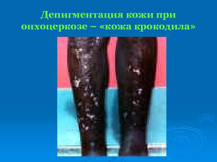 Депигментация кожи при онхоцеркозе – «кожа крокодила» 