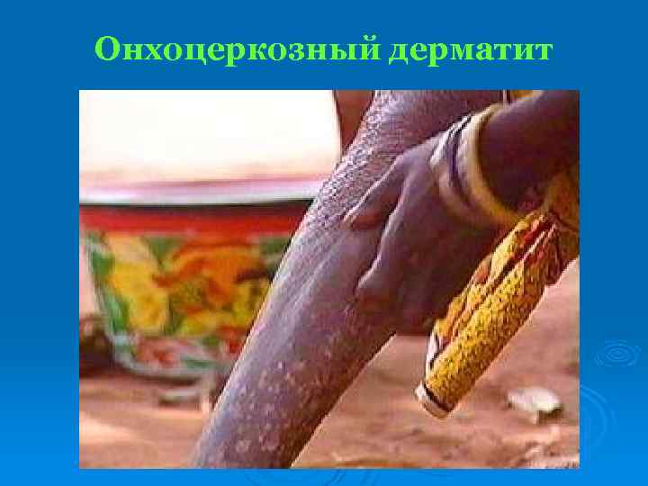 Онхоцеркозный дерматит 