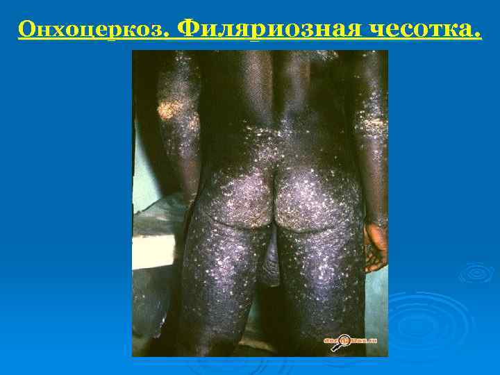 Онхоцеркоз. Филяриозная чесотка. 