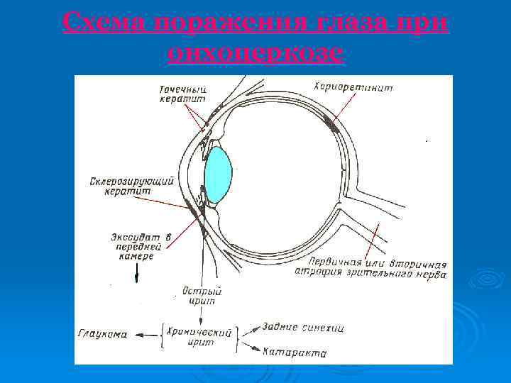 Схема поражения глаза при онхоцеркозе 
