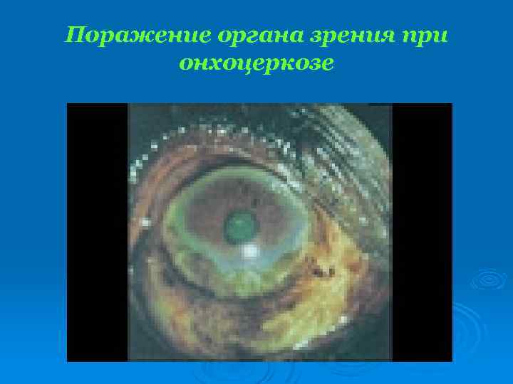 Поражение органа зрения при онхоцеркозе 