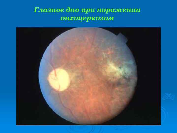 Глазное дно при поражении онхоцеркозом 