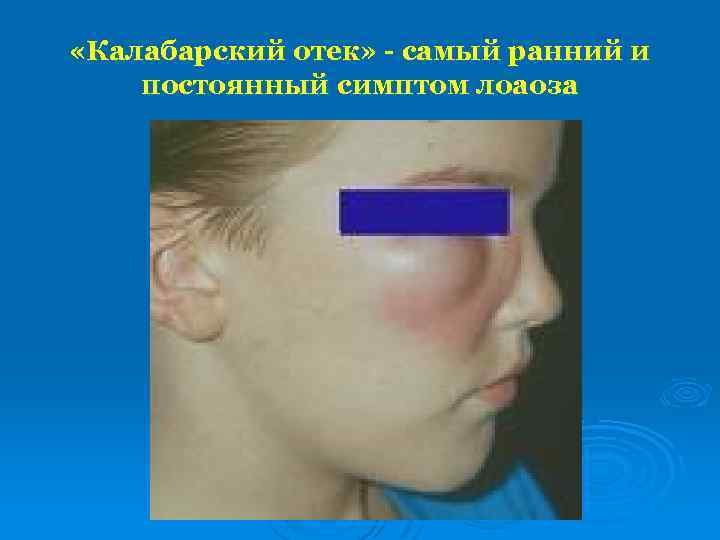  «Калабарский отек» - самый ранний и постоянный симптом лоаоза 