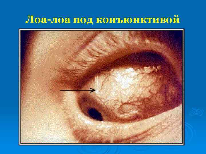 Лоа-лоа под конъюнктивой 