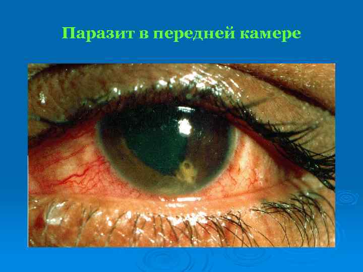 Паразит в передней камере 