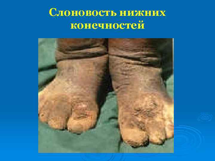Слоновость нижних конечностей 