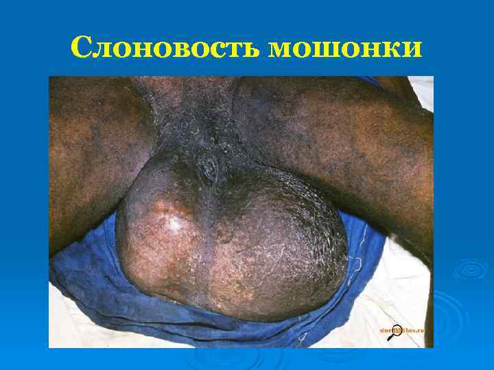 Слоновость мошонки 