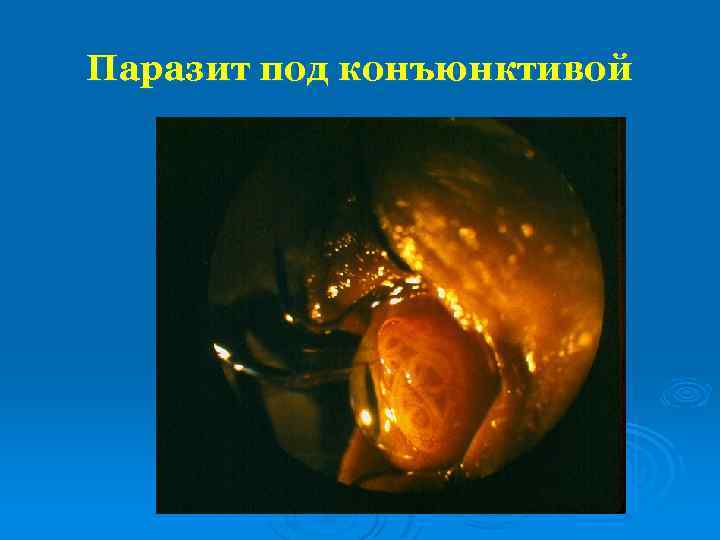 Паразит под конъюнктивой 