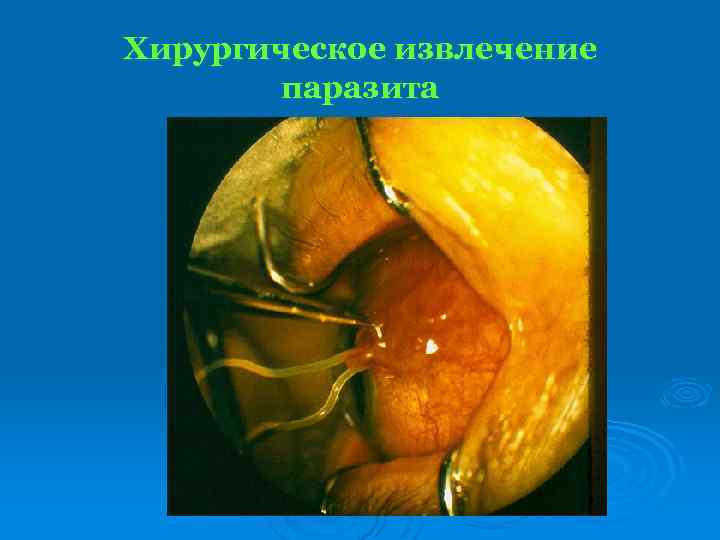 Хирургическое извлечение паразита 