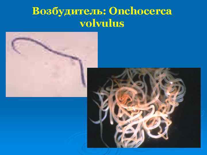 Возбудитель: Onchocerca volvulus 