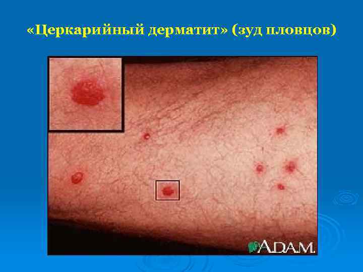  «Церкарийный дерматит» (зуд пловцов) 