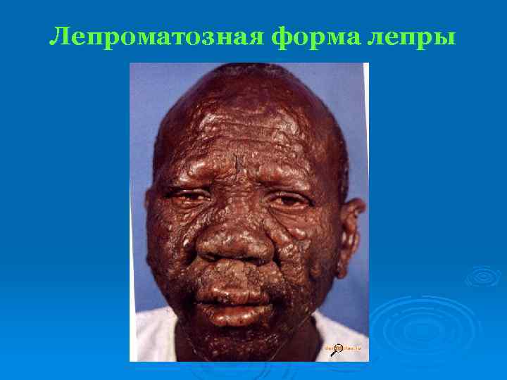 Лепроматозная форма лепры 