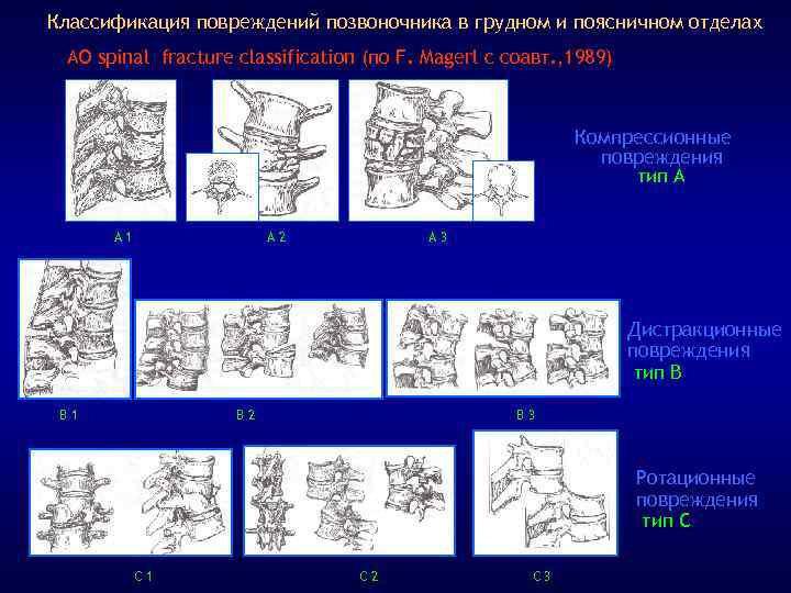 Классификация повреждений позвоночника в грудном и поясничном отделах АО spinal fracture classification (по F.