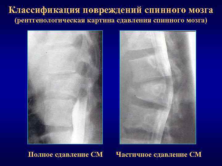 Классификация повреждений спинного мозга (рентгенологическая картина сдавления спинного мозга) Полное сдавление СМ Частичное сдавление