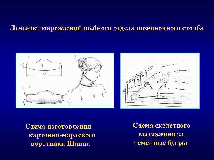 Лечение повреждений шейного отдела позвоночного столба Схема изготовления картонно марлевого воротника Шанца Схема скелетного