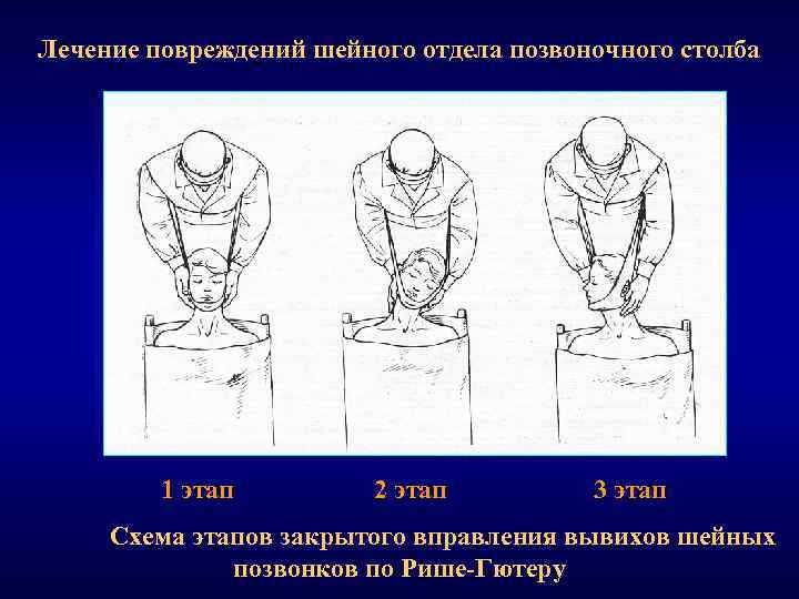 Лечение повреждений шейного отдела позвоночного столба 1 этап 2 этап 3 этап Схема этапов