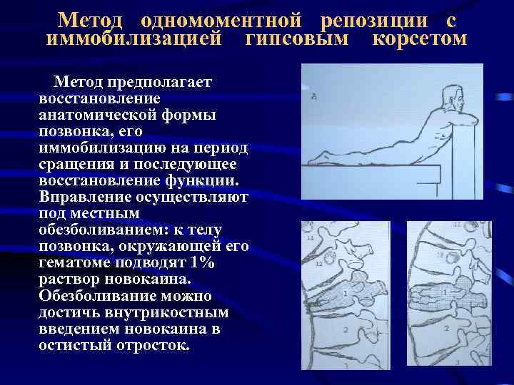 Метод одномоментной репозиции с иммобилизацией гипсовым корсетом Метод предполагает восстановление анатомической формы позвонка, его