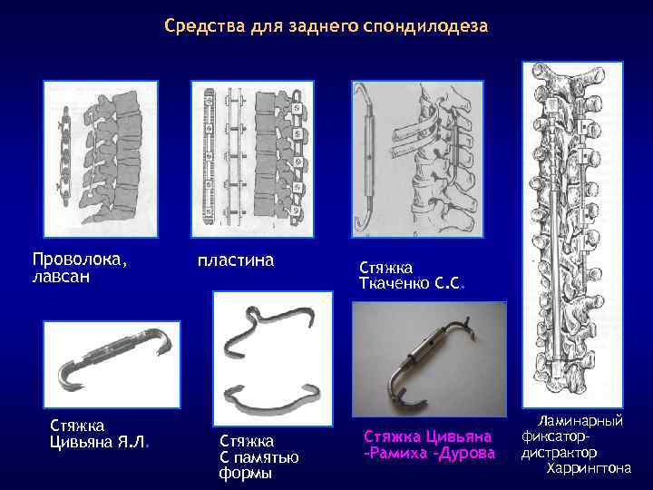 Средства для заднего спондилодеза Проволока, лавсан Стяжка Цивьяна Я. Л. пластина Стяжка С памятью