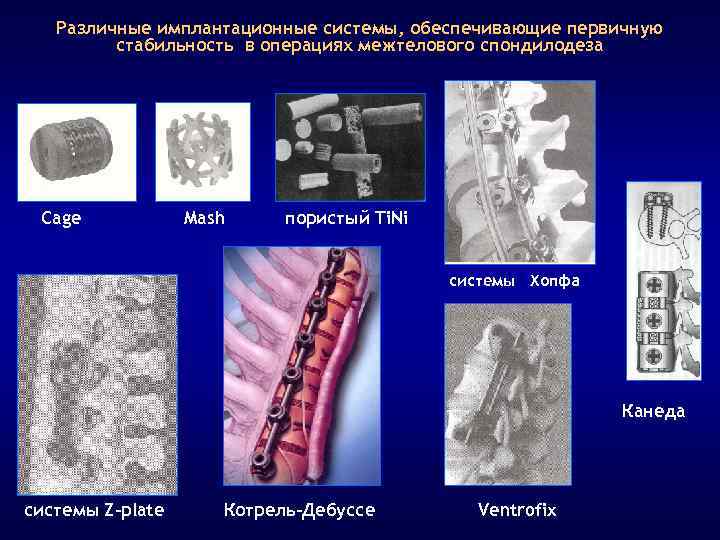 Различные имплантационные системы, обеспечивающие первичную стабильность в операциях межтелового спондилодеза Cage Mash пористый Ti.