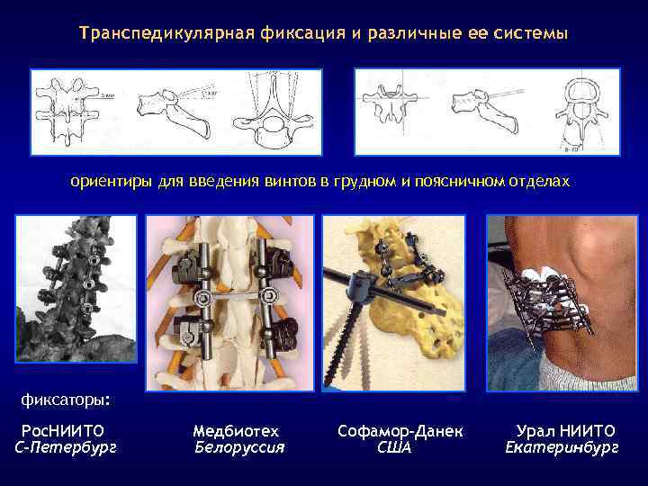 Транспедикулярная фиксация и различные ее системы ориентиры для введения винтов в грудном и поясничном