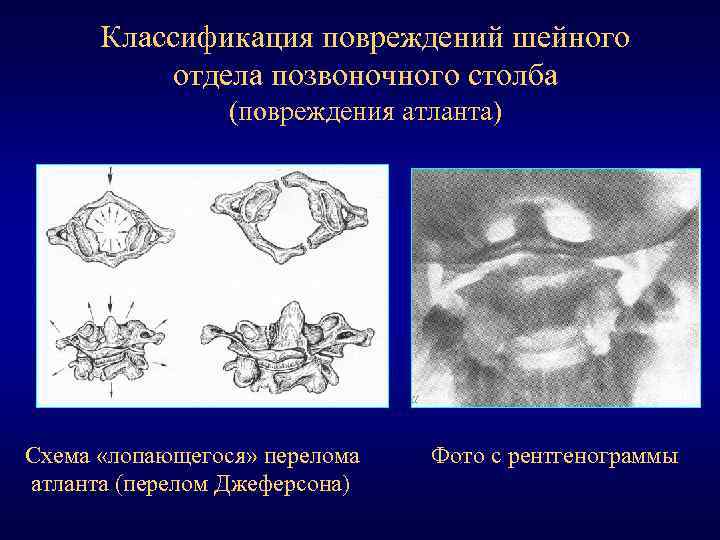 Классификация повреждений шейного отдела позвоночного столба (повреждения атланта) Схема «лопающегося» перелома атланта (перелом Джеферсона)