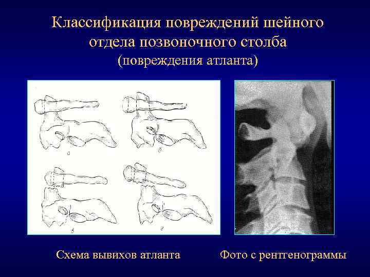 Классификация повреждений шейного отдела позвоночного столба (повреждения атланта) Схема вывихов атланта Фото с рентгенограммы