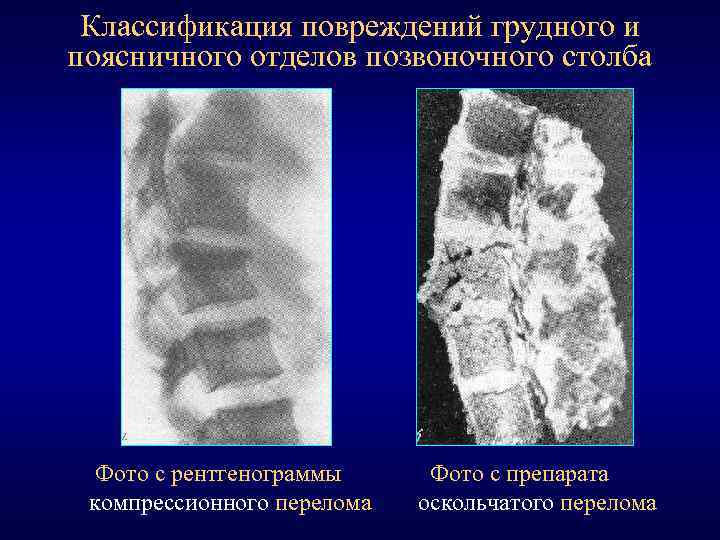 Классификация повреждений грудного и поясничного отделов позвоночного столба Фото с рентгенограммы компрессионного перелома Фото