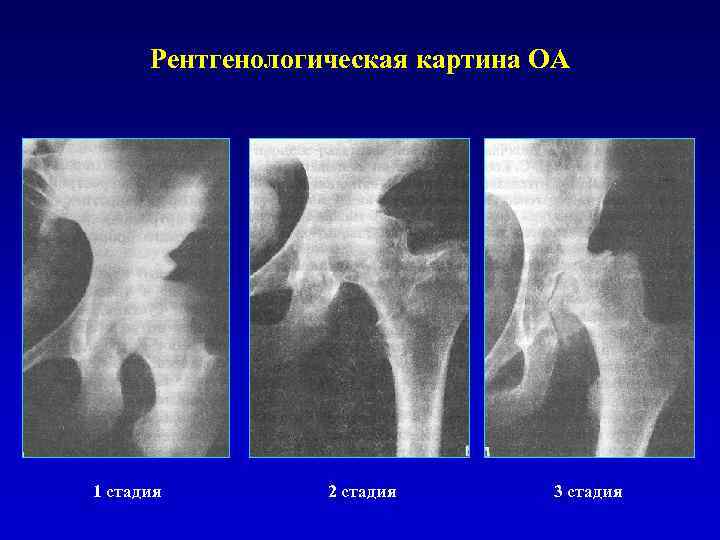 Рентгенологическая картина ОА 1 стадия 2 стадия 3 стадия 