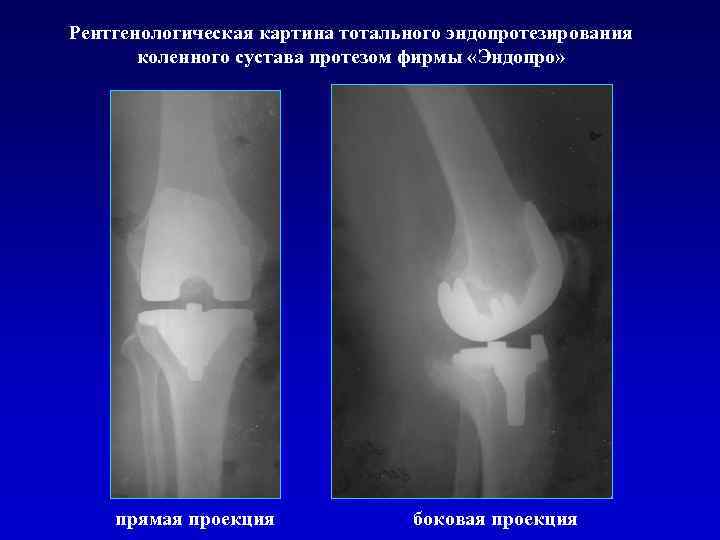 Рентгенологическая картина тотального эндопротезирования коленного сустава протезом фирмы «Эндопро» прямая проекция боковая проекция 