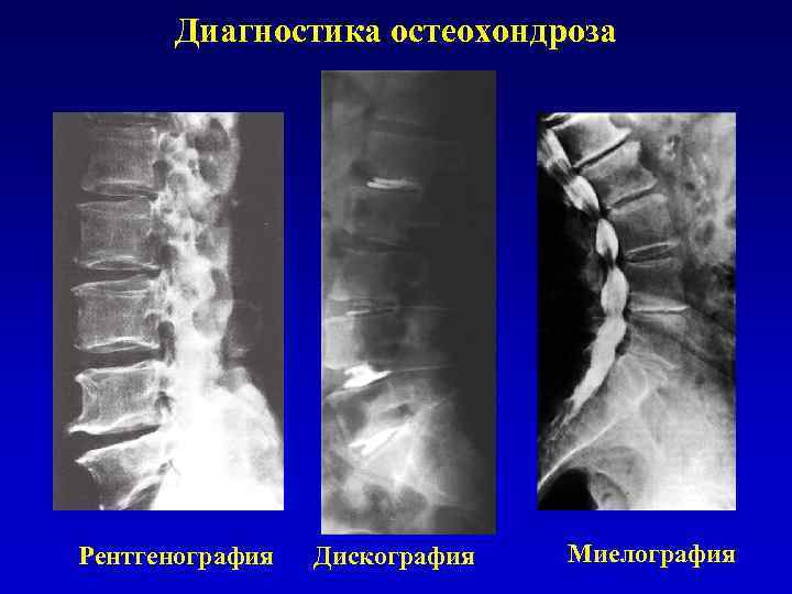 Диагностика остеохондроза Рентгенография Дискография Миелография 