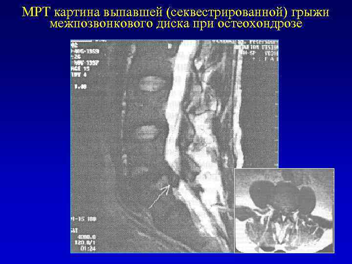 МРТ картина выпавшей (секвестрированной) грыжи межпозвонкового диска при остеохондрозе 