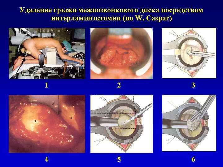 Удаление грыжи межпозвонкового диска посредством интерламинэктомии (по W. Caspar) 1 2 3 4 5