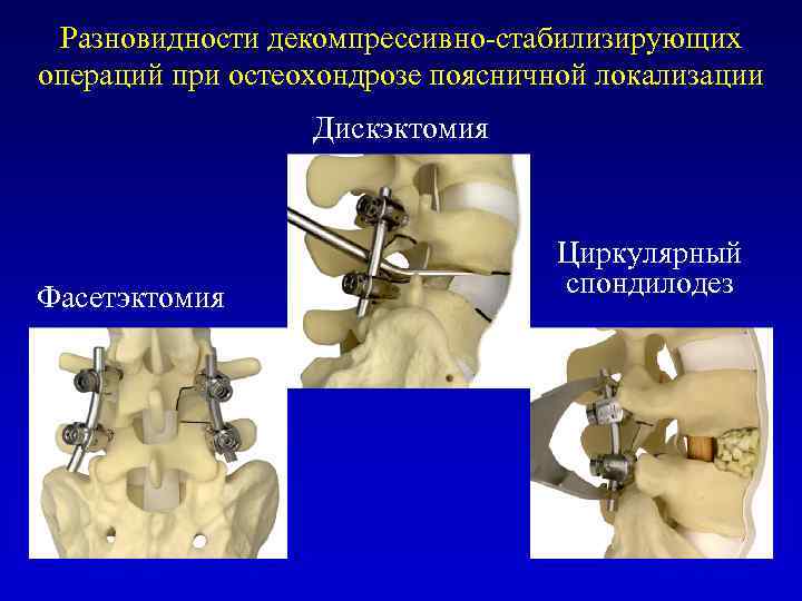 Разновидности декомпрессивно-стабилизирующих операций при остеохондрозе поясничной локализации Дискэктомия Фасетэктомия Циркулярный спондилодез 