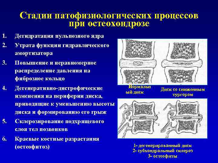 Грудной остеохондроз карта вызова