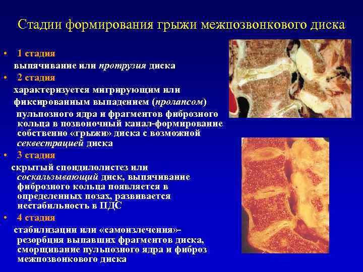 Стадии формирования грыжи межпозвонкового диска • 1 стадия выпячивание или протрузия диска • 2