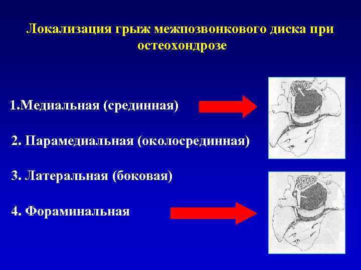 Хондроз грудной карта вызова