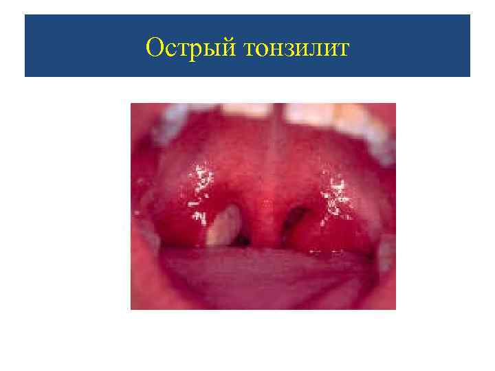 Острый тонзилит 