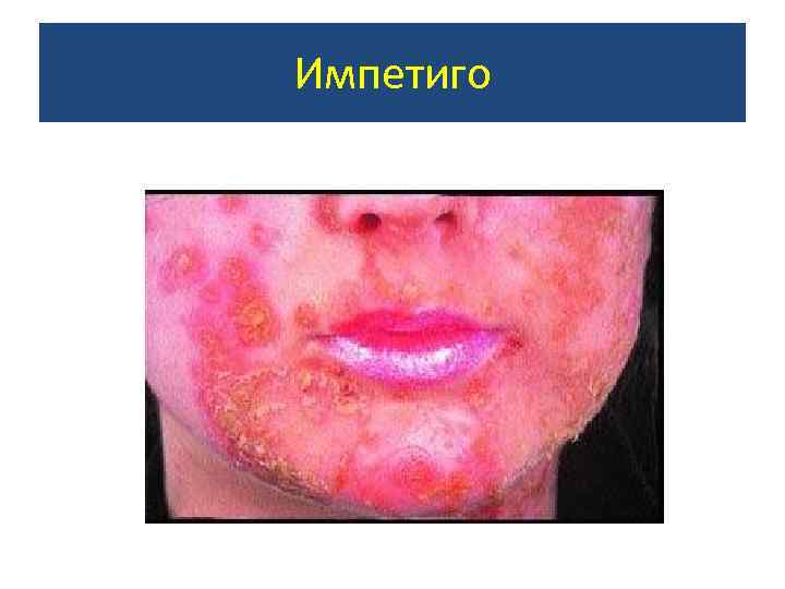 Импетиго 