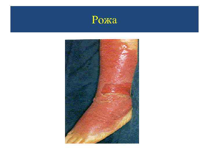 Рожа 