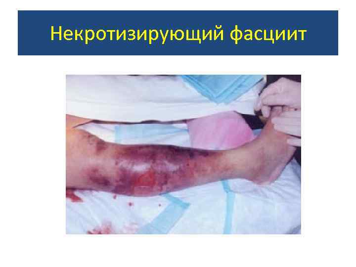 Некротизирующий фасциит 