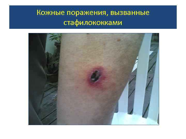 Кожные поражения, вызванные стафилококками 